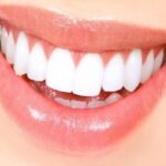 carillas dentales