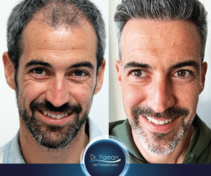 Trasplante Capilar en Turquía: Antes y Después