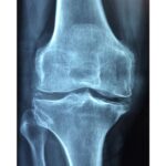 Osteoporosis