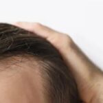 Persona con alopecia