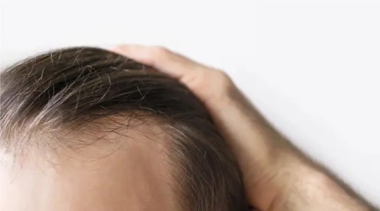 Persona con alopecia